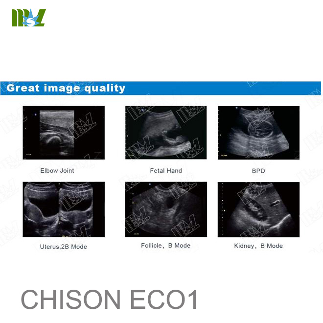 ecografo chison eco 1