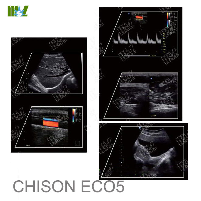 ecografo chison eco 5