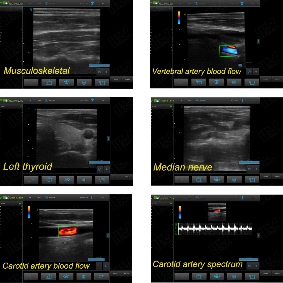 abdominal aortic aneurysm