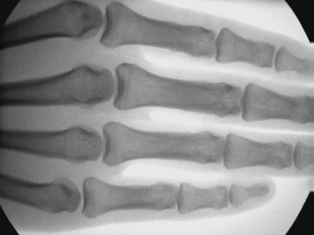 hand x ray