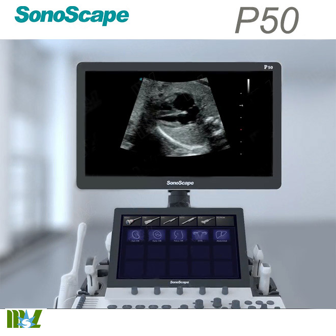 sonoscape ultrasound