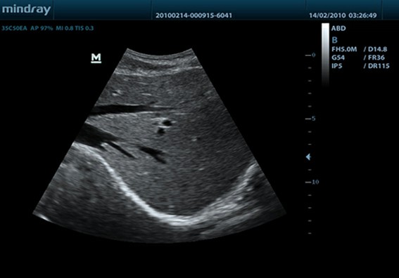 indray ultrasound