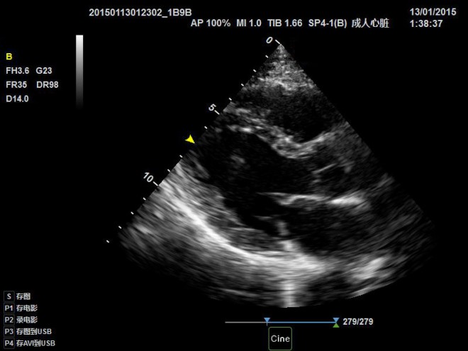 ultrasound scan