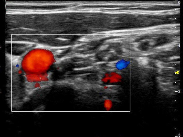 diagnostic ultrasound